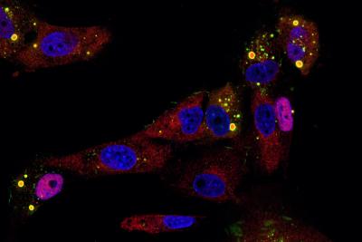 Human bronchial epithelial cells with staining for RSV protein (green), NFKB p65 (red) and DNA (blue). 